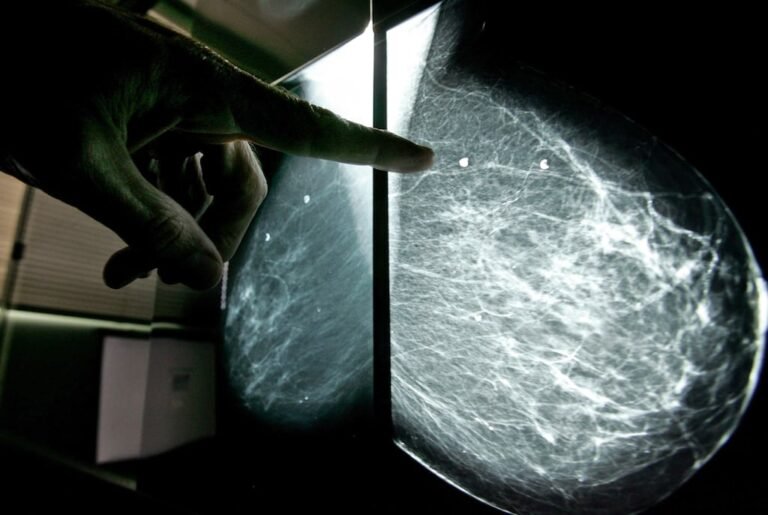 cáncer de mama